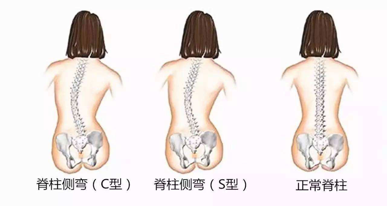 坐月子脊柱侧弯的危害 第2张-备孕-孕期检查-孕产妇食谱-胎教育儿